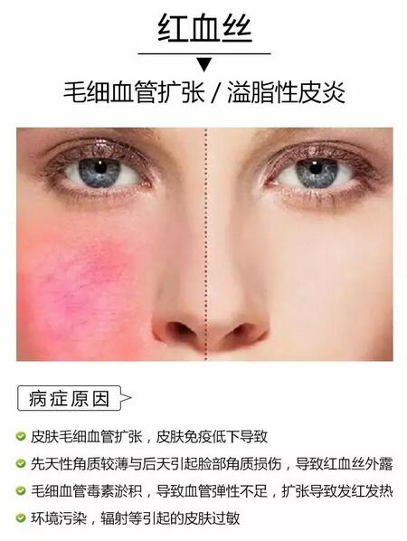 980激光去红血丝仪器