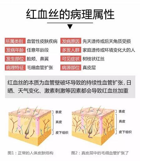 980激光去红血丝仪器
